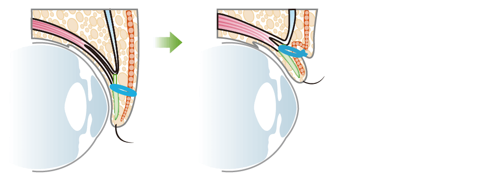 埋没式重瞼術(上まぶた二重埋没法)