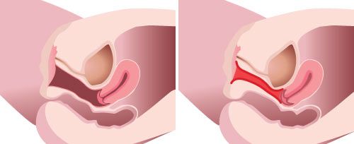 Dr.衣理式インティマレーザー イメージ