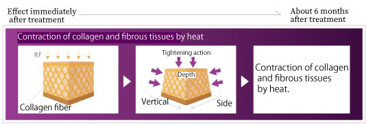 effect of thermageFLX