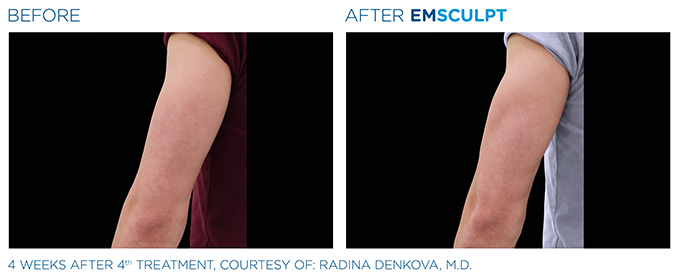 エムスカルプト (二の腕)