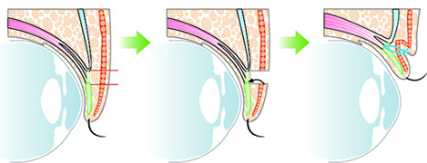 全切開重瞼術