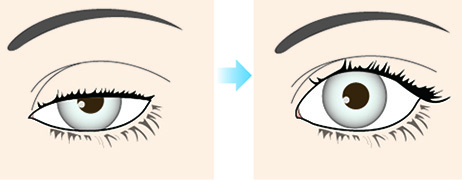 眼瞼下垂手術