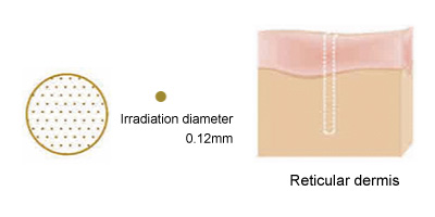 Irradiation diameter
0.12mm Reticular dermis