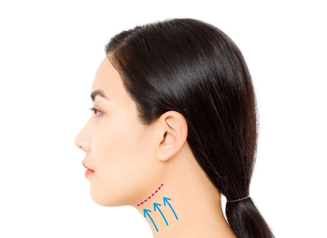 顎下リフトイメージイラスト